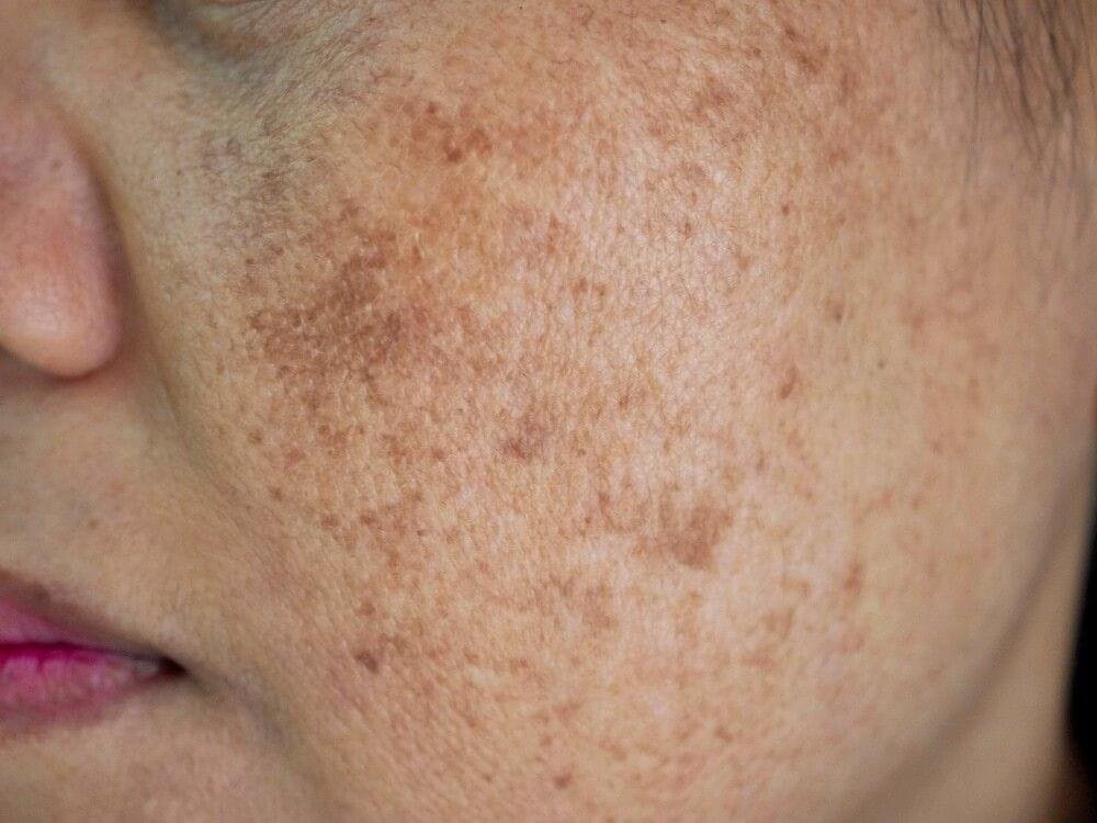 Chemical Peel for Pigmentation Removal